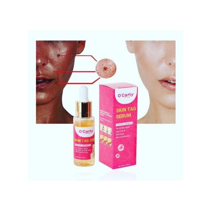 O'Carly Skin Tag Remover Serum