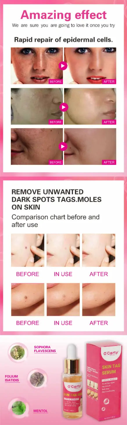 O'Carly Skin Tag Remover Serum