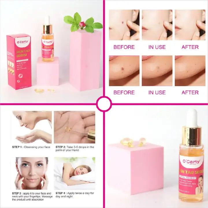 O'Carly Skin Tag Remover Serum