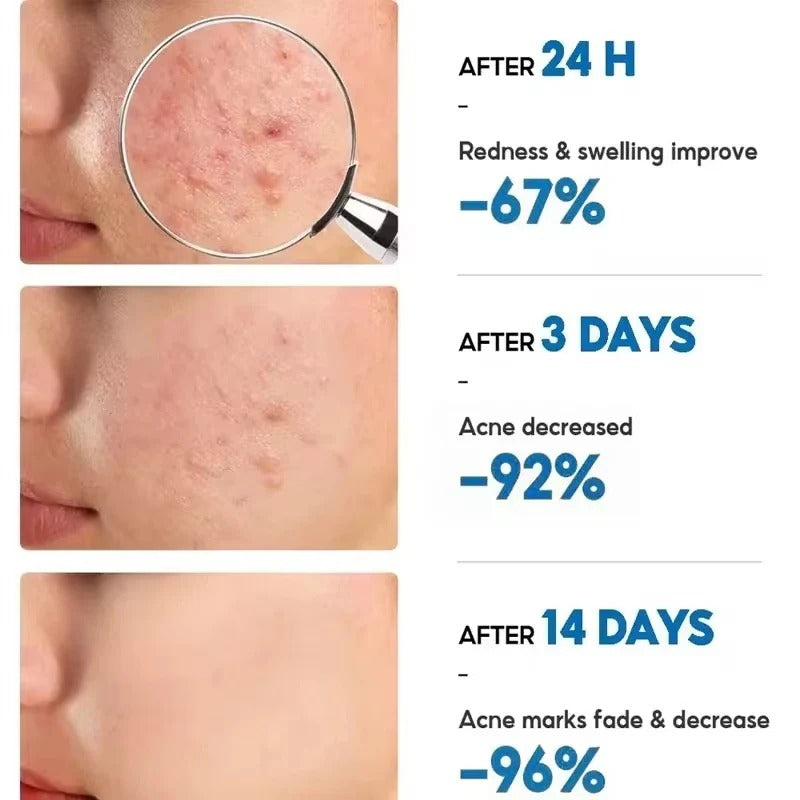 KORMESIC Acne Gel
