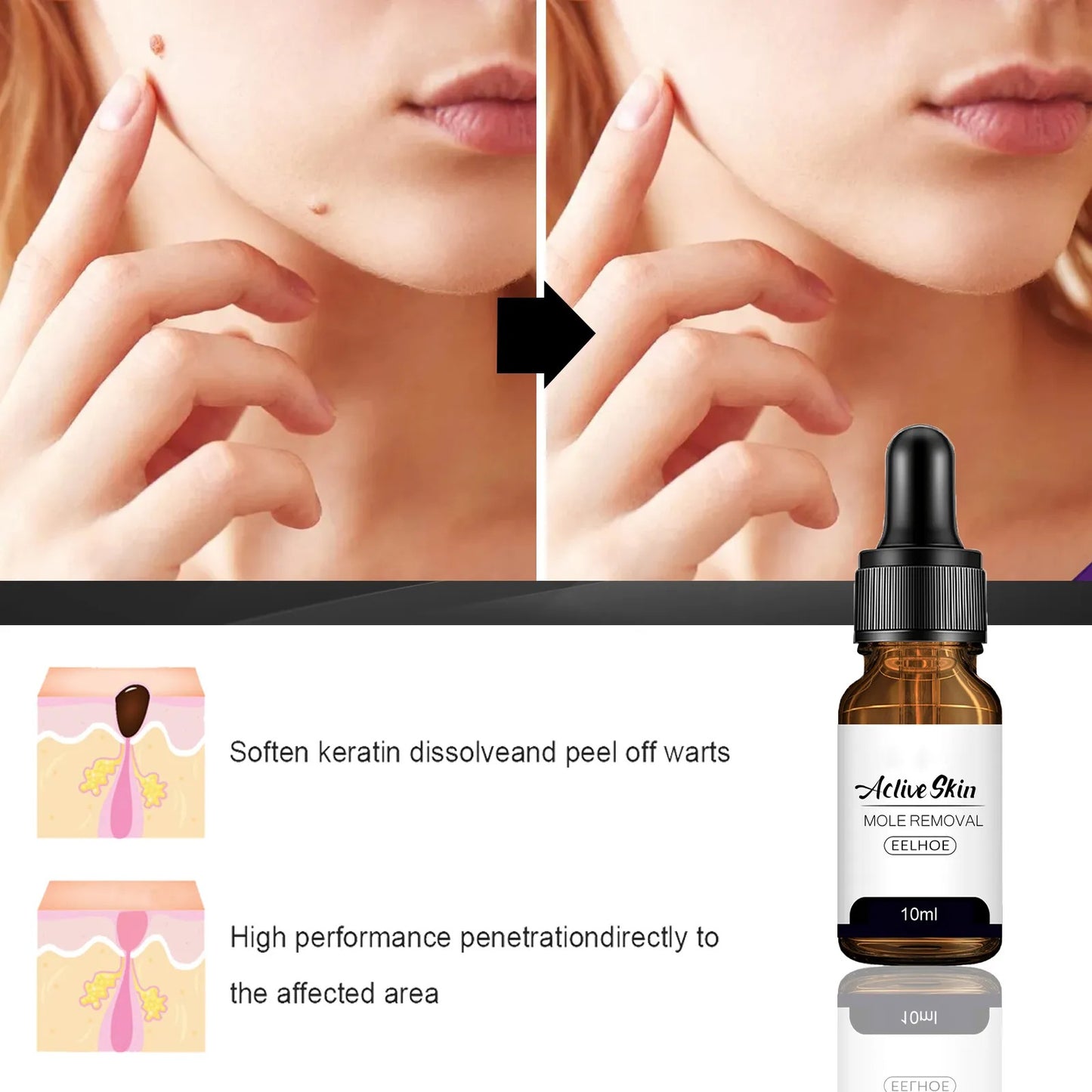 EELHOE Active Skin Mole Removal Serum