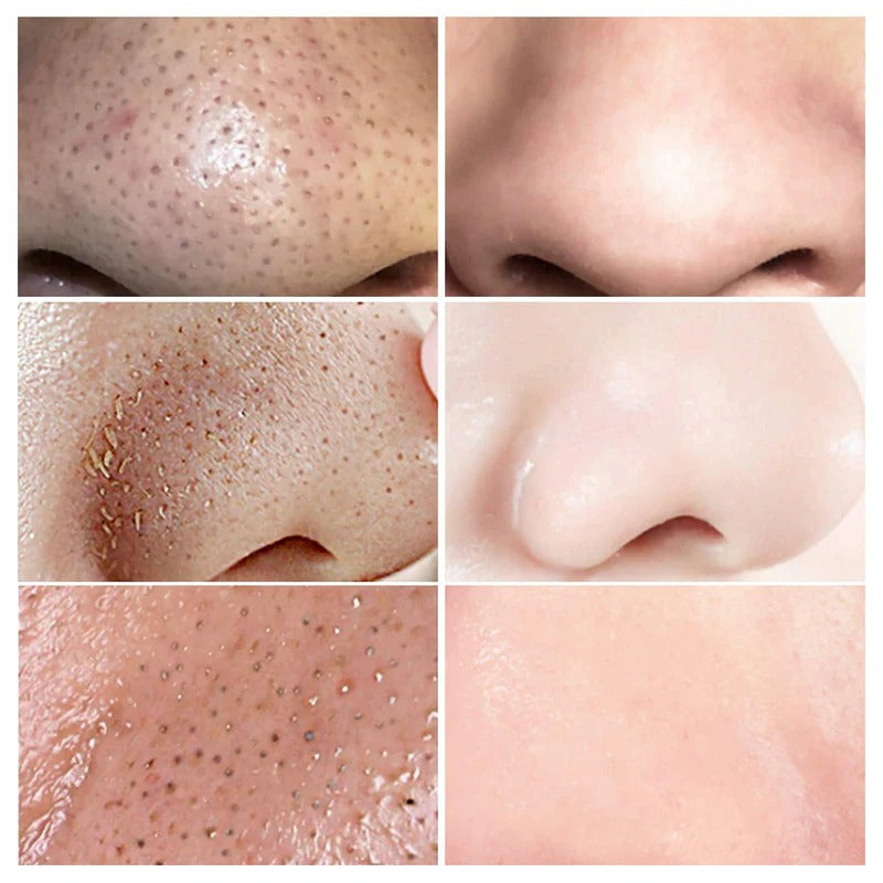 Lanbena Blackhead Remover Mask