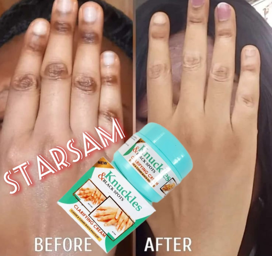 Skin Beauty Black Spot Cream | Erase Dark Knuckles & Elbows ⨠Skin Beauty Black Spot Cream ā Fade Dark Knuckles, Elbows & Knees Fast | Clinically Proven Results | Save KSh 25%!Fast | LIMITED STOCK + Surprise Gift! - SAVE KSh 300 TODAY (a)
