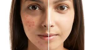 pimples,acne and dark spots control