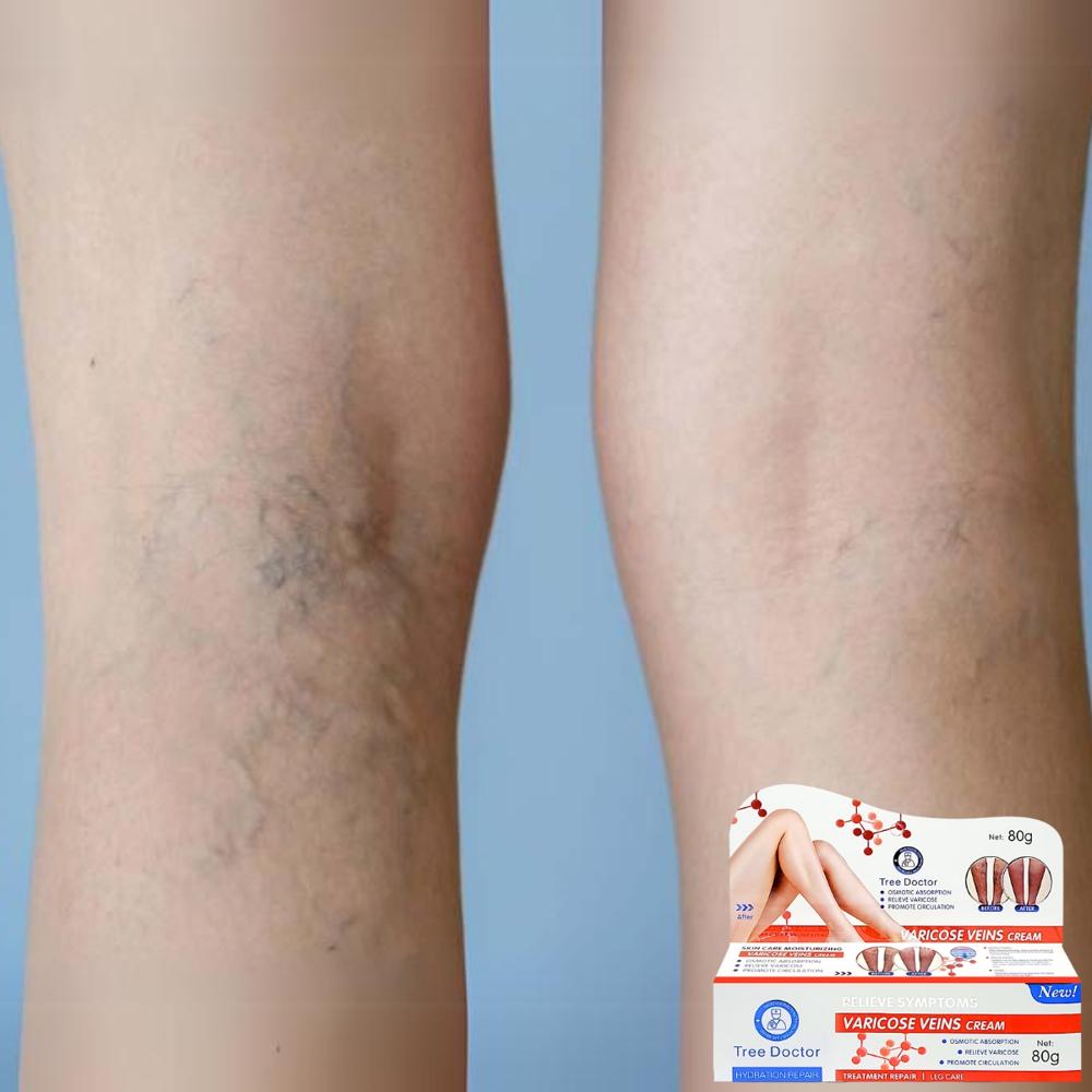 Tree Doctor Varicose Veins Cream 80g