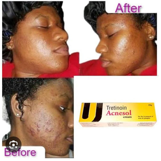 Acnesol Tretinoin Acne & Pimples Treatment Cream – 25g
