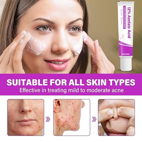 Sauvasine Azelaic Acid 12% Facial Cream with Hyaluronic Acid & Niacinamide – Fade Dark Spots, Acne & Redness B