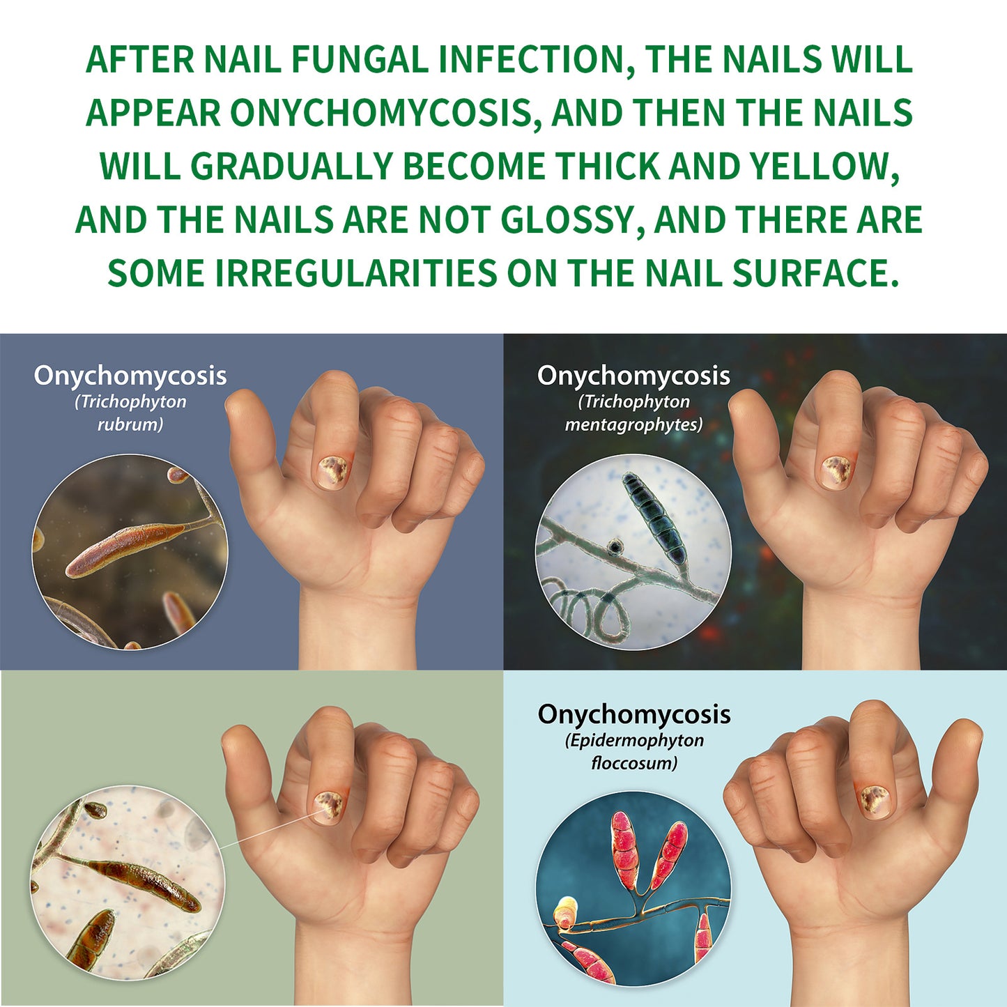 Jaysuing 7 Days Nail Fungus Treatment