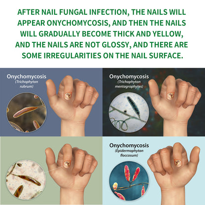 Jaysuing 7 Days Nail Fungus Treatment