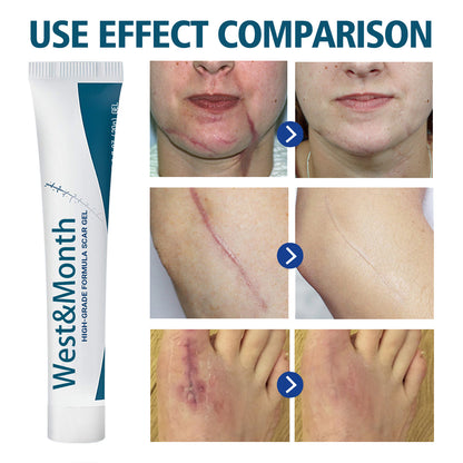 West & Month High Grade Formula Scar Gel