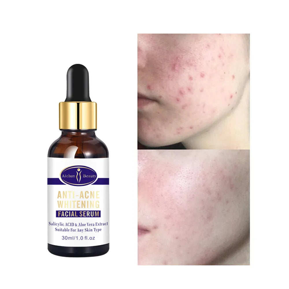 Aichun Beauty Anti-Acne Whitening Facial Serum