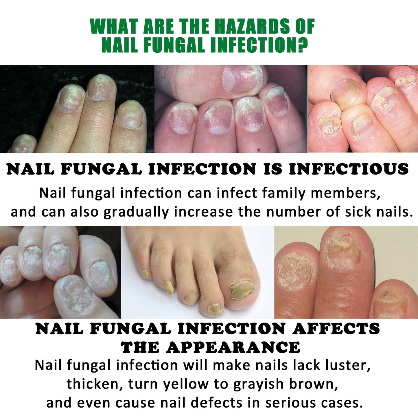 Jaysuing 7 Days Nail Fungus Treatment