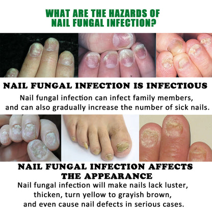 Jaysuing 7 Days Nail Fungus Treatment