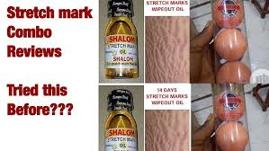 Shalom stretch mark oil