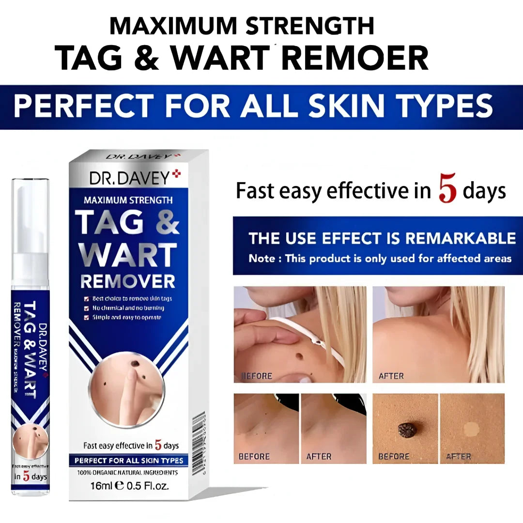 Dr Davey Maximum Strength Tag & Wart Remover | Dries Out & Drops Off Naturally in 10 Days | Discreet Delivery Countrywide
