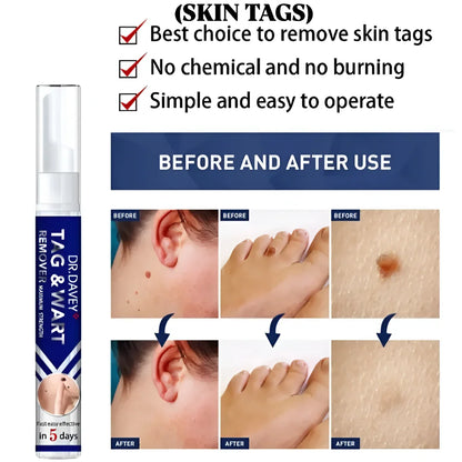 Dr Davey Maximum Strength Tag & Wart Remover | Dries Out & Drops Off Naturally in 10 Days | Discreet Delivery Countrywide