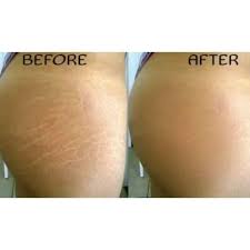 TVO Stretch Marks Skin Repair Cream