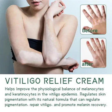 Sumifun Vitiligo Relief Cream