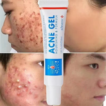 KORMESIC Acne Gel