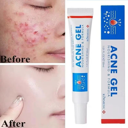 KORMESIC Acne Gel
