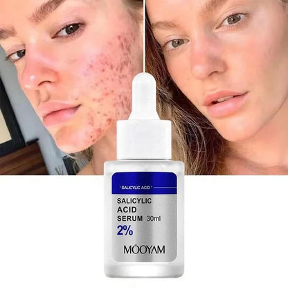 MOOYAM Salicylic Acid 2% Serum (30ml)