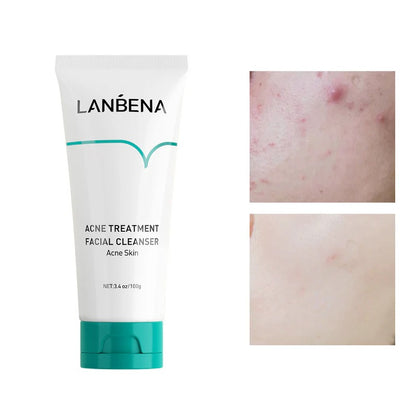 LANBENA Acne Treatment Facial Cleanser