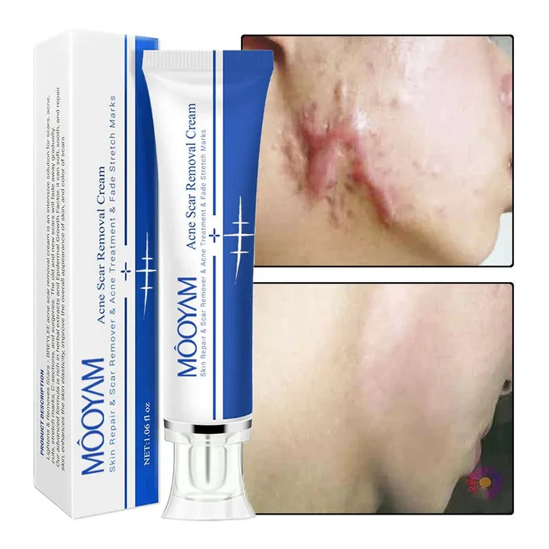 MOOYAM Strong Effective Acne Scar Removal Cream