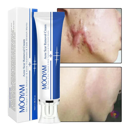 MOOYAM Strong Effective Acne Scar Removal Cream