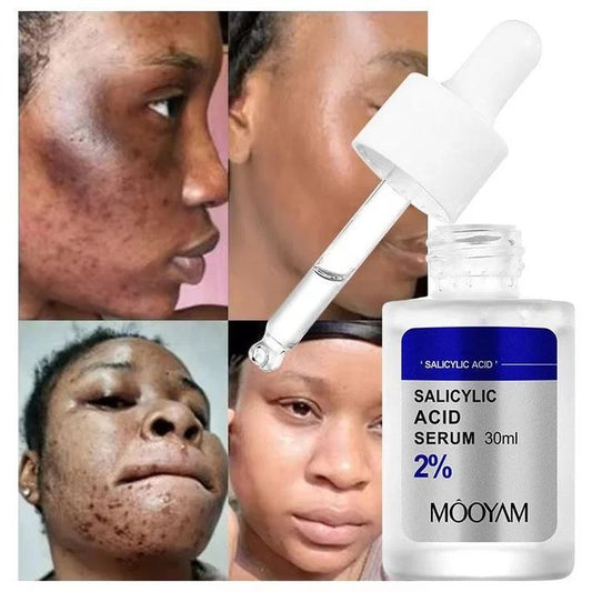 MOOYAM Salicylic Acid 2% Serum (30ml)