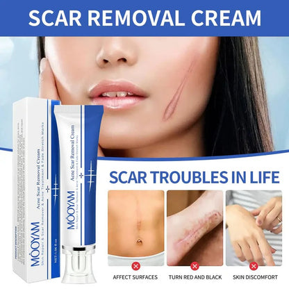 MOOYAM Strong Effective Acne Scar Removal Cream