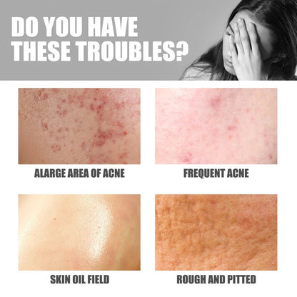 Jaysuing Butt Acne Treatment Cream (30 g)