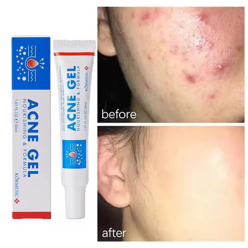 KORMESIC Acne Gel