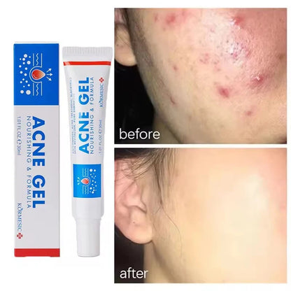 KORMESIC Acne Gel