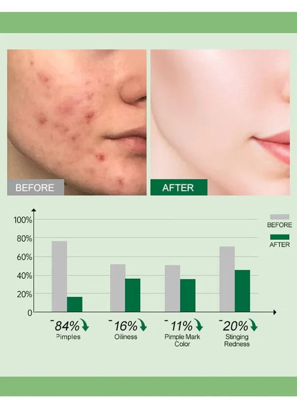 JoyPretty Acne Control Cream with Tea Tree Oil & Vitamin B3 (Niacinamide)