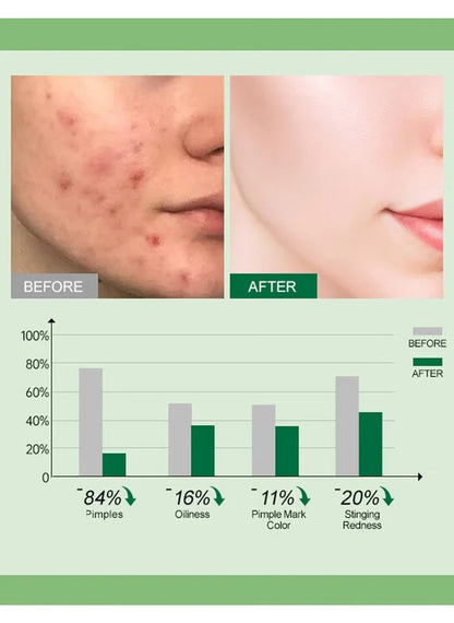 JoyPretty Acne Control Cream with Tea Tree Oil & Vitamin B3 (Niacinamide)