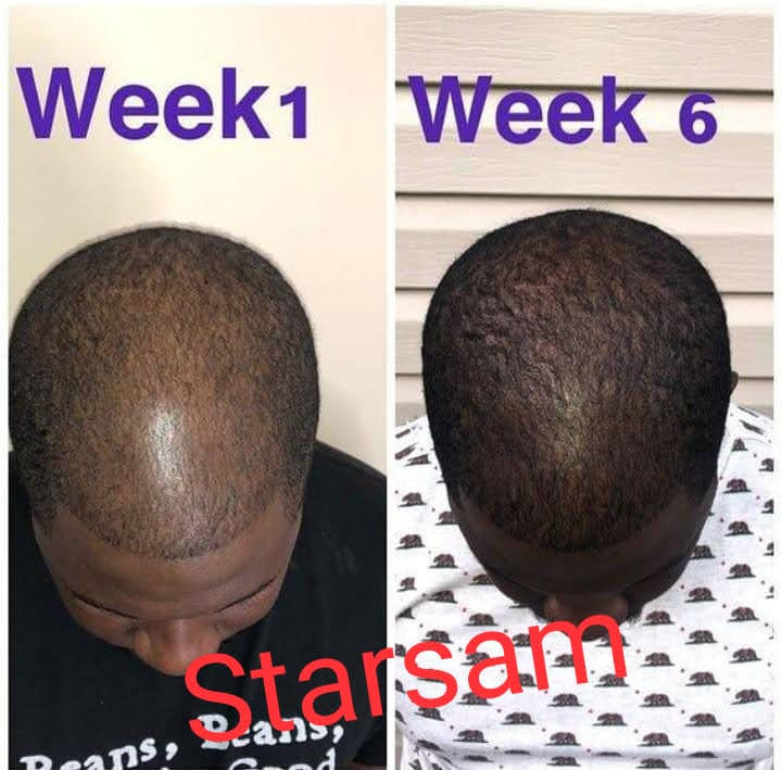 🔥 BUY 1 GET 1 FREE — King of Ginger 7-Day Hair Growth Oil | Stop Breakage + Regrow Hair | KSh 1,800 (E)