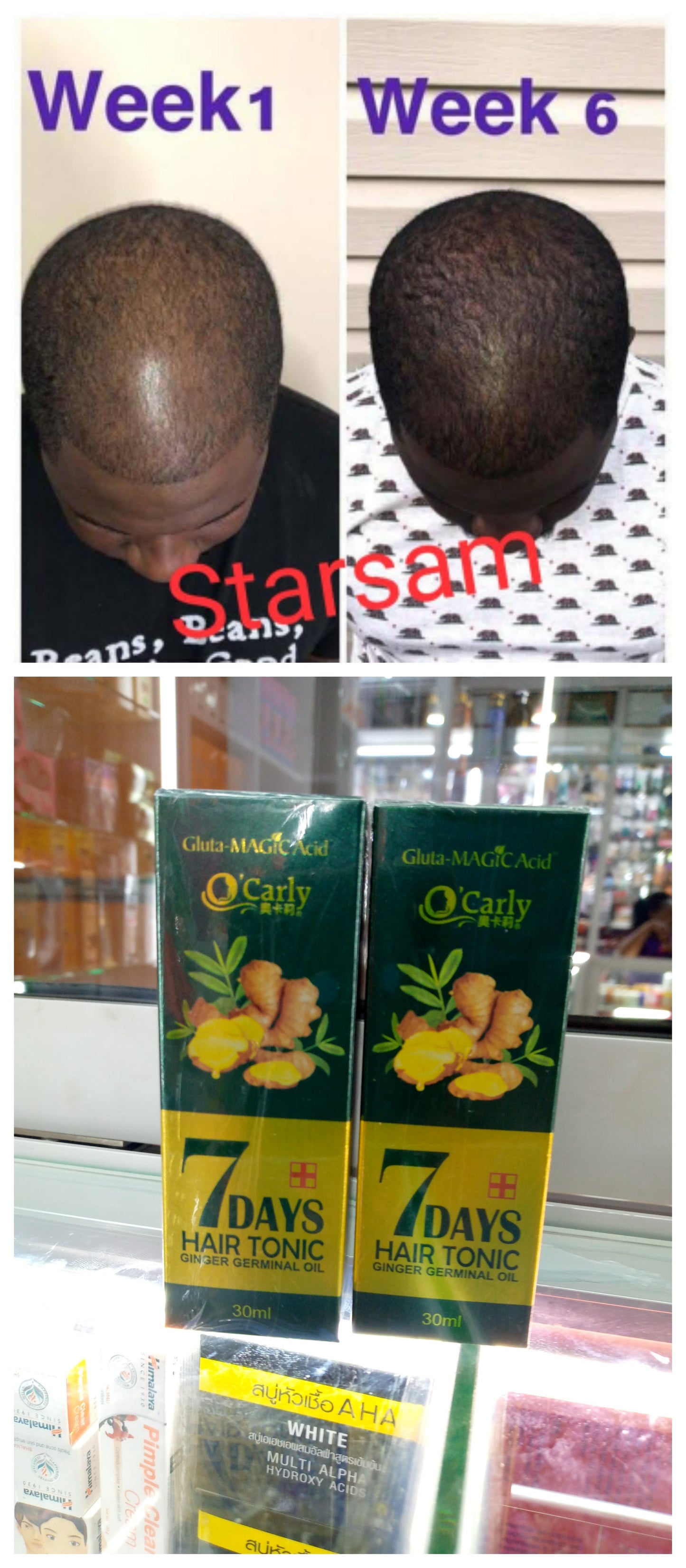 🔥 BUY 1 GET 1 FREE — King of Ginger 7-Day Hair Growth Oil | Stop Breakage + Regrow Hair | KSh 1,800 (E)