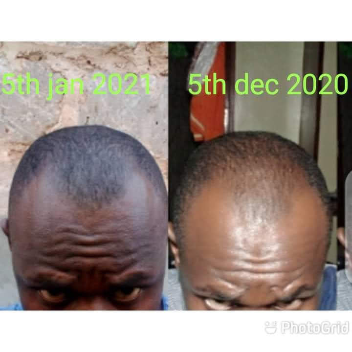 🔥 BUY 1 GET 1 FREE — King of Ginger 7-Day Hair Growth Oil | Stop Breakage + Regrow Hair | KSh 1,800 (E)