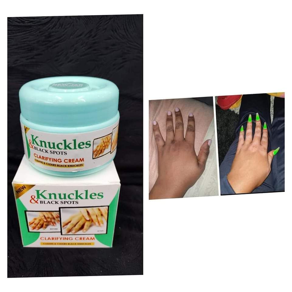 Skin Beauty Black Spot Cream | Erase Dark Knuckles & Elbows ✨ Skin Beauty Black Spot Cream — Fade Dark Knuckles, Elbows & Knees Fast | Clinically Proven Results | Save KSh 25%!Fast | LIMITED STOCK + Surprise Gift! - SAVE KSh 300 TODAY (a)