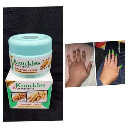 Skin Beauty Black Spot Cream | Erase Dark Knuckles & Elbows ✨ Skin Beauty Black Spot Cream — Fade Dark Knuckles, Elbows & Knees Fast | Clinically Proven Results | Save KSh 25%!Fast | LIMITED STOCK + Surprise Gift! - SAVE KSh 300 TODAY (a)