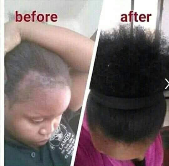 🔥 BUY 1 GET 1 FREE — King of Ginger 7-Day Hair Growth Oil | Stop Breakage + Regrow Hair | KSh 1,800 (D)