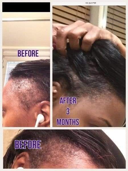 🔥 BUY 1 GET 1 FREE — King of Ginger 7-Day Hair Growth Oil | Stop Breakage + Regrow Hair | KSh 1,800 (E)
