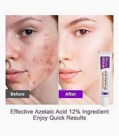 Sauvasine Azelaic Acid 12% Facial Cream with Hyaluronic Acid & Niacinamide – Fade Dark Spots, Acne & Redness A